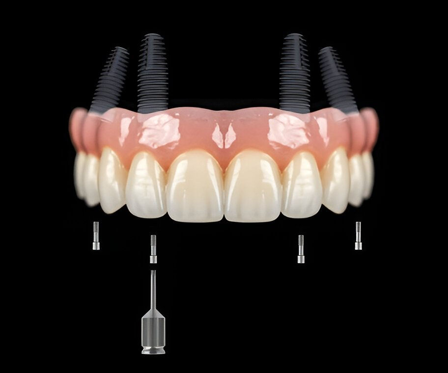 3D illustration of a full arch dental implant system with abutments and screws