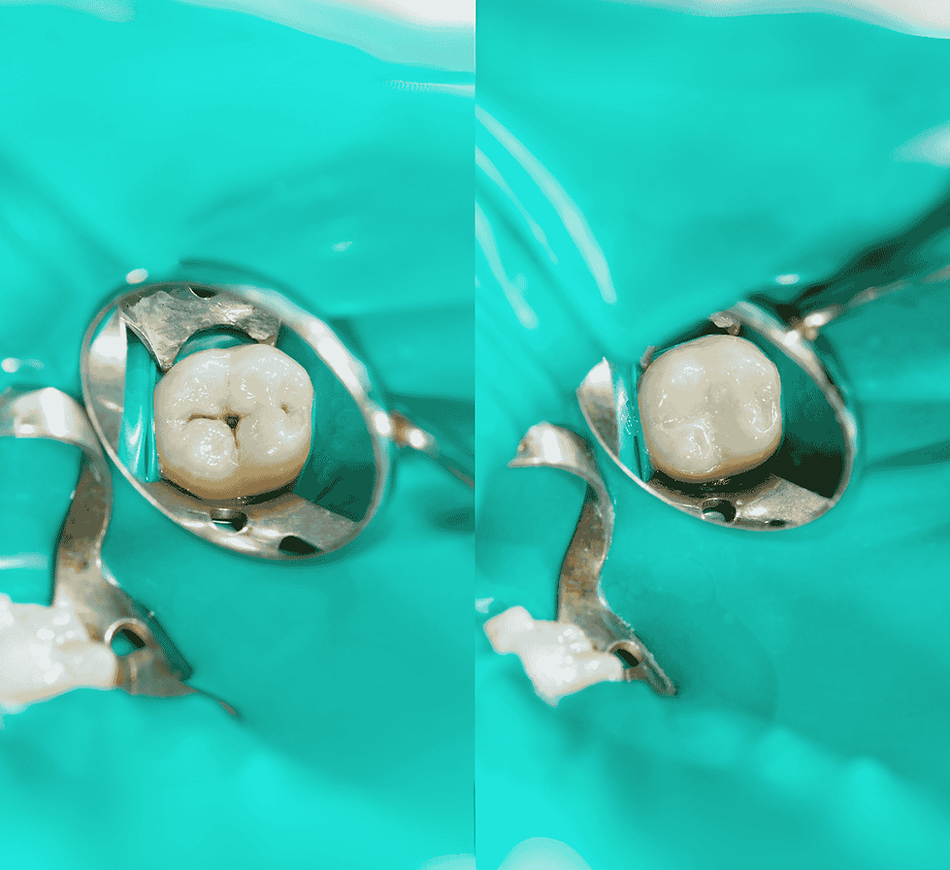 Close-up of a molar tooth with a dental filling under a rubber dam