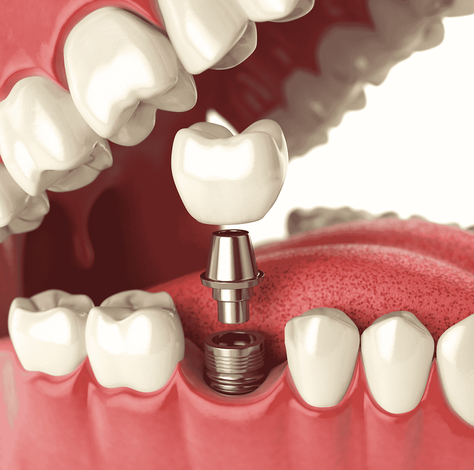 3D rendering of a dental implant with crown placement in the lower jaw