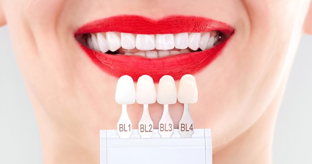 Close-up of veneer shade matching for bright white smile