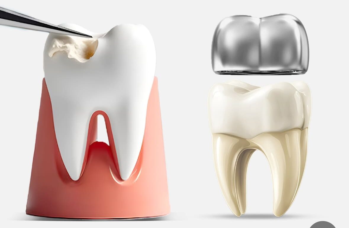 Illustration comparing dental fillings and crowns for tooth restoration
