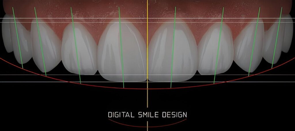 dental veneers
